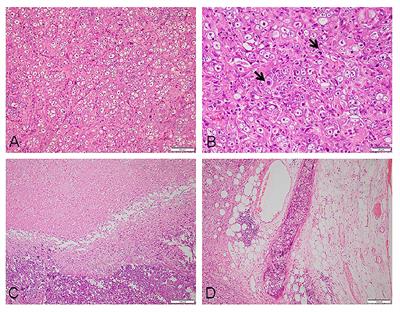 Case report: EBV-positive epithelioid follicular dendritic cell sarcoma with CD30 expression: a highly challenging diagnosis